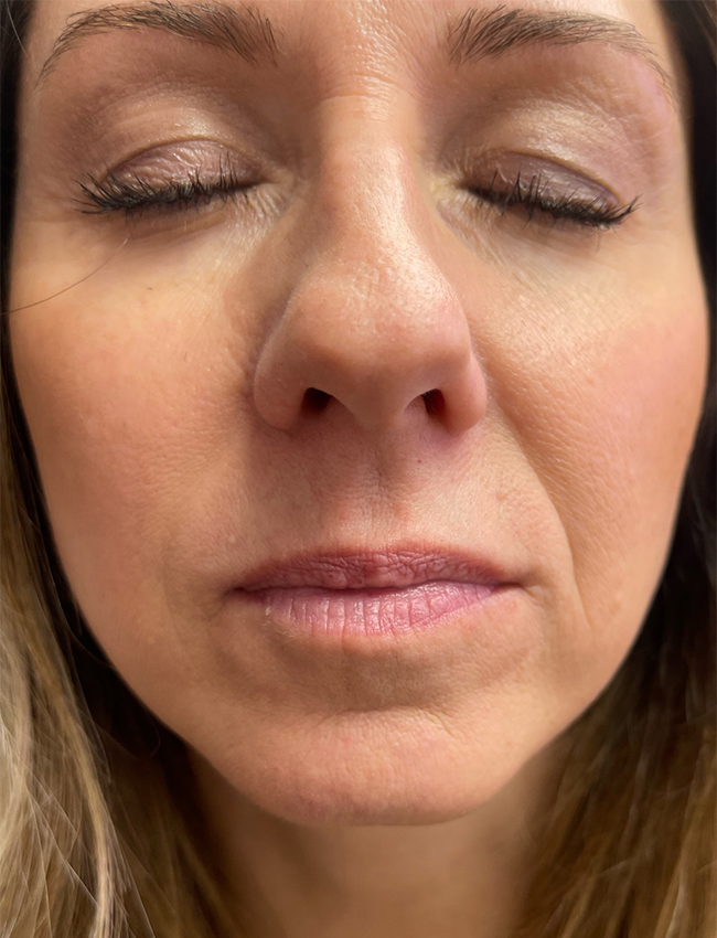 Lip Filler Our Little Secret Aesthetics